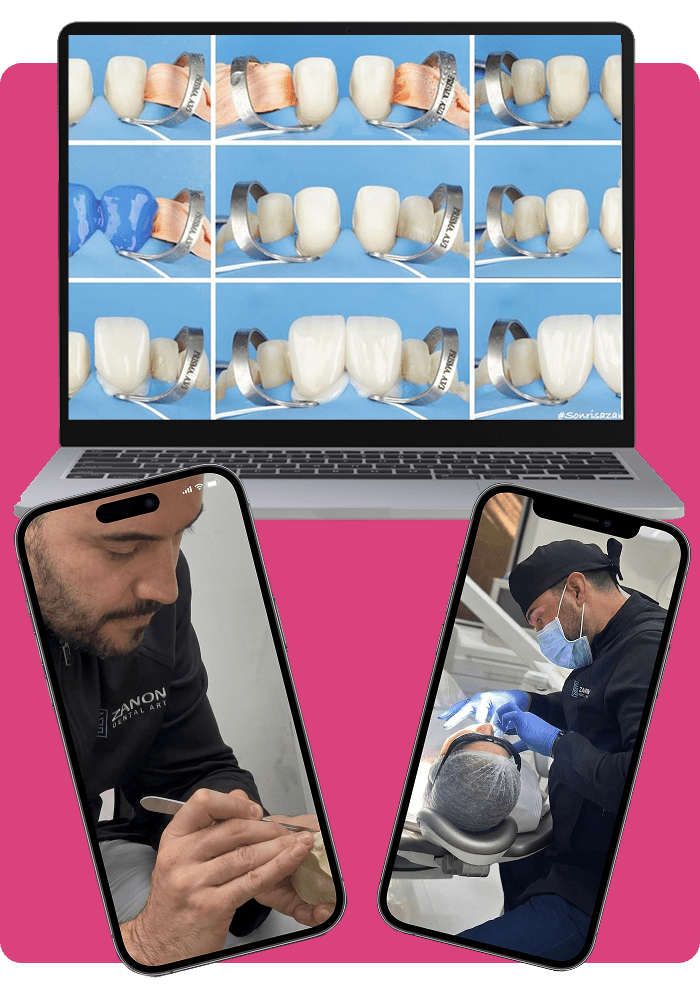 Curso de resinas indiretas