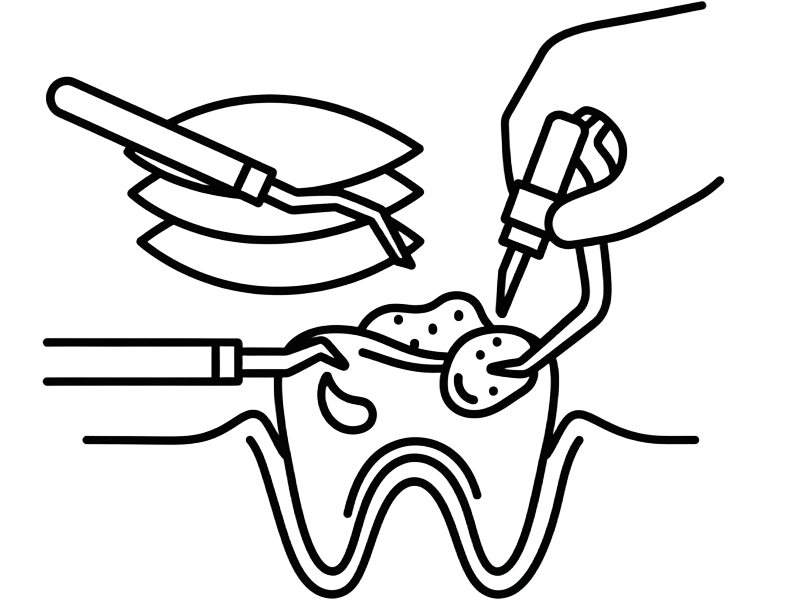 Execução das Resinas Indiretas